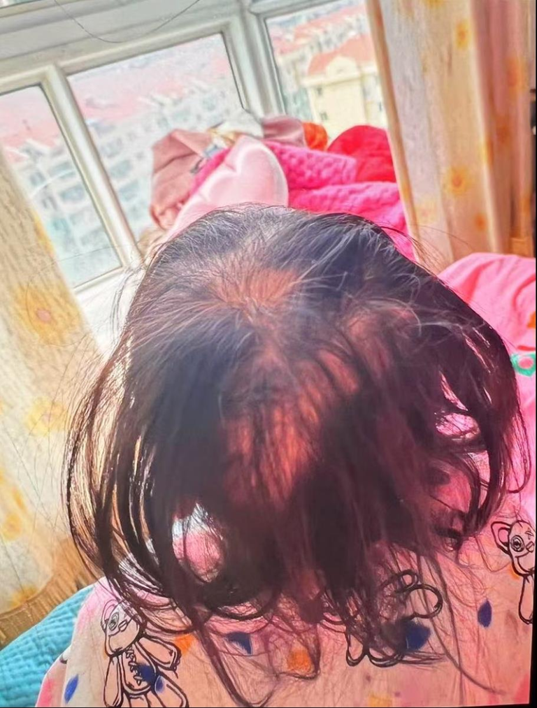 湖南3岁女童大把脱发，被查出铊中毒。(取材自潇湘晨报)