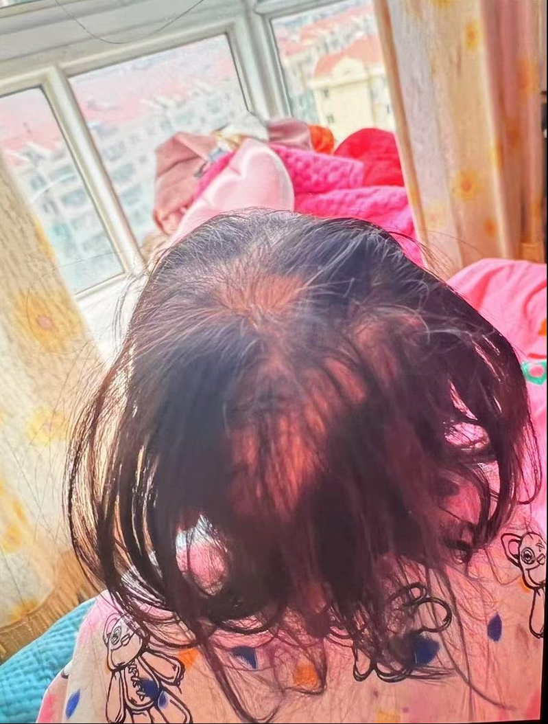 湖南3岁女童大把脱发,被查出铊中毒。(取材自潇湘晨报)