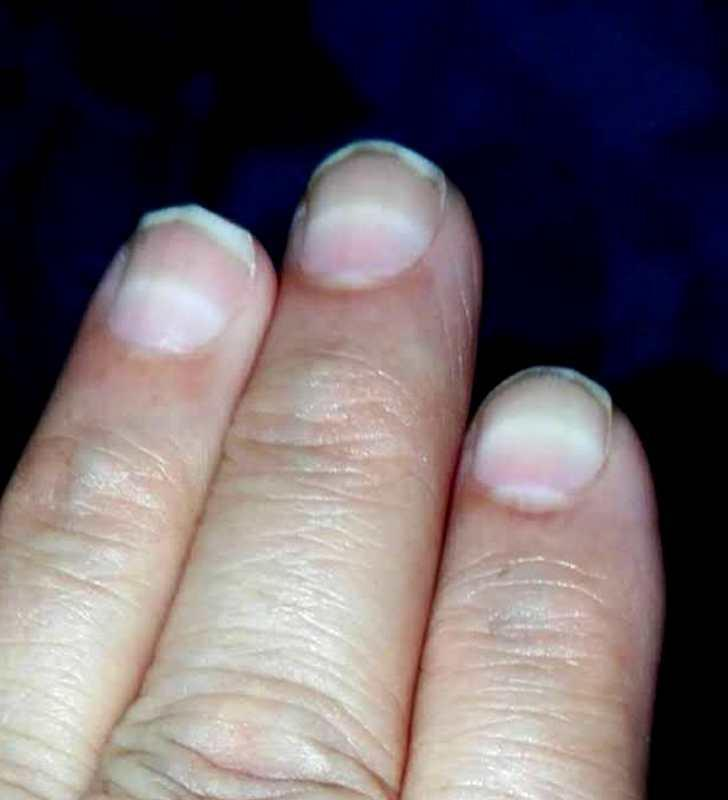湖南3岁女童大把脱发，被查出铊中毒。(取材自潇湘晨报)
