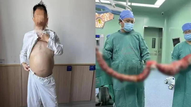 方先生4个月未排便,腹部肿胀如怀胎十月的孕妇,手术后医生取出「巨蟒」般的病肠重达20多斤。(取材自紫牛新闻)
