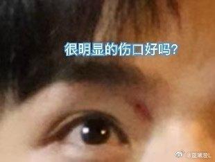 龚俊在参与海外综艺节目「地球超新鲜」时，玩游戏不慎伤了右眼。(取材自微博)