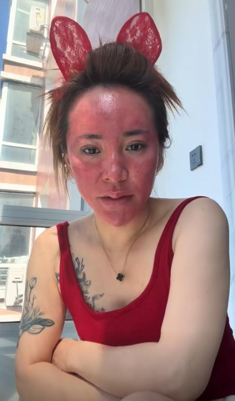 吉林女子变成「关公脸」，不敢出门。(视频截屏)
