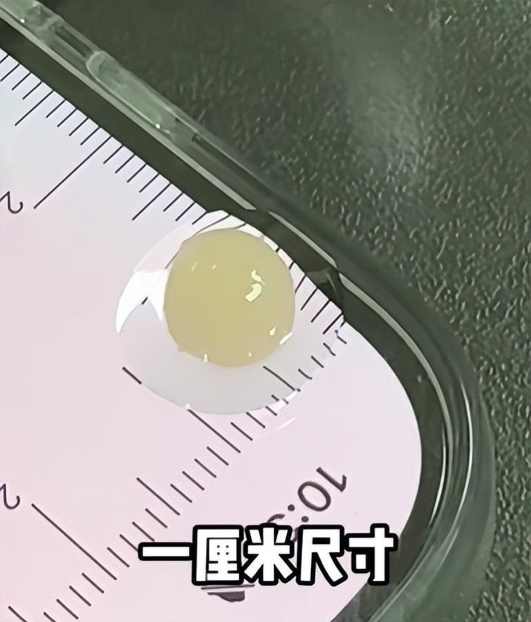 一颗直径一厘米的「肉块」。（取材自新民晚报）