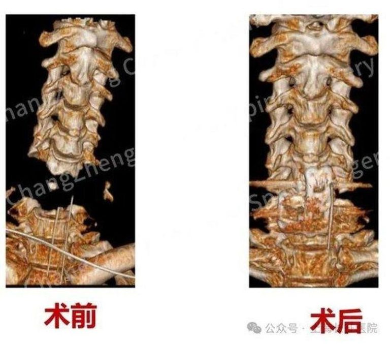 陈华江教授、王新伟教授与麻醉科团队紧密协同完成手术。（取材自极目新闻）