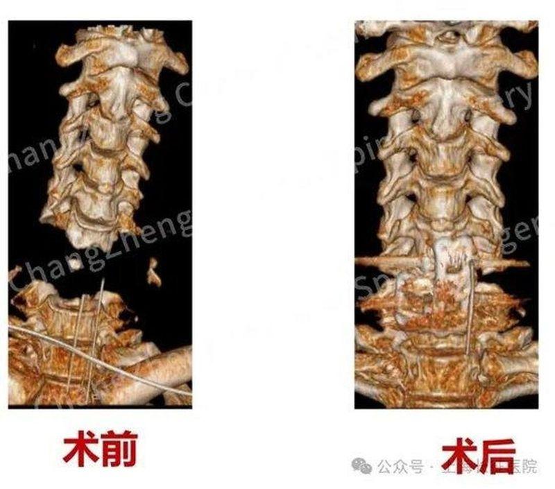 陈华江教授、王新伟教授与麻醉科团队紧密协同完成手术。（取材自极目新闻）