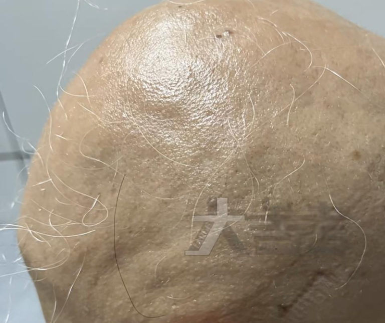 女子的头发突然全部脱落。（取材自大参考）