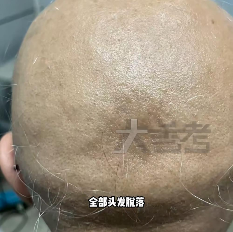 女子的头发突然全部脱落。（取材自大参考）