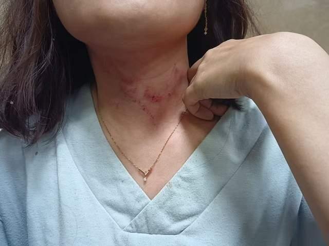 薛芯脖子四周一片通红,并留有深深的伤痕。(取材自大风新闻)