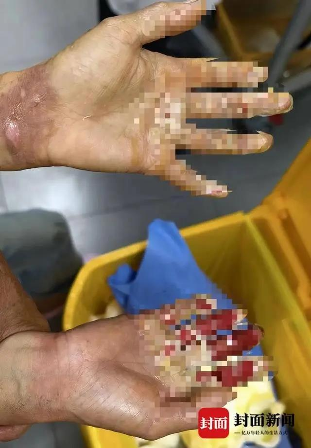 将儿子救出后,刘萍的双手也被烧伤。(取材自封面新闻)