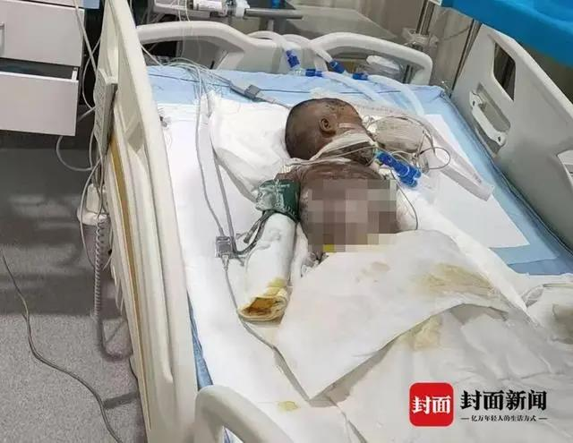 将儿子救出后,刘萍的双手也被烧伤。(取材自封面新闻)