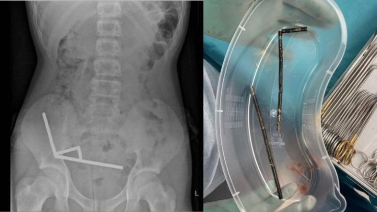 新西兰男童吞100磁铁引发剧烈腹痛，切除部分肠道后脱离险境。(取材自新西兰医学期刊)