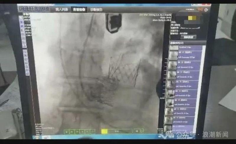 患者实际被植入了两个心脏瓣膜。(取材自浪潮新闻)