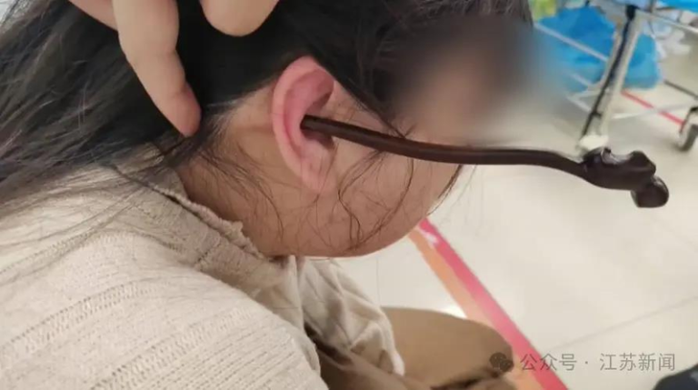 吓人 女子睡前没摘发簪 夜里翻身插入耳朵直抵后脑勺 江苏一名女子睡前未取下发簪,睡觉翻身时,发簪从右耳插入,直抵后脑勺。(取材自江苏新闻)