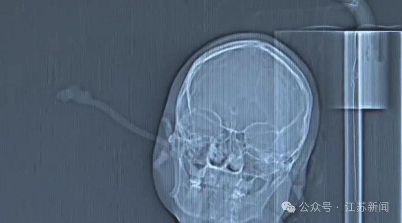 江苏一名女子睡前未取下发簪,睡觉翻身时,发簪从右耳插入,直抵后脑勺。(取材自江苏新闻)