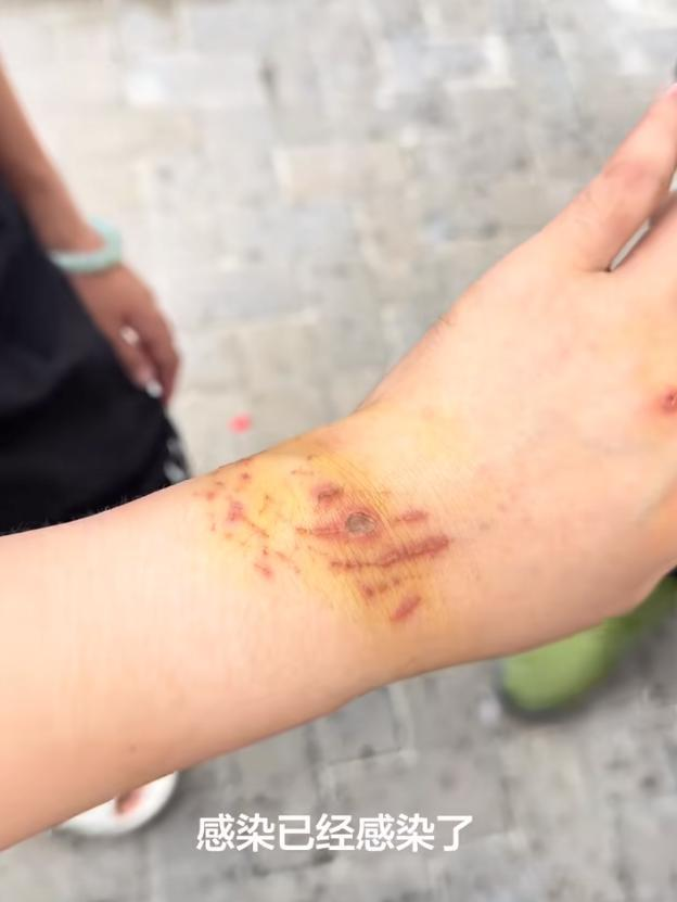 中国女游客被护士鲨咬到手。(视频截屏)