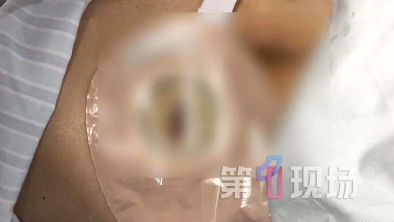 胡先生便秘十多天,紧急送医。(取材自第一现场)