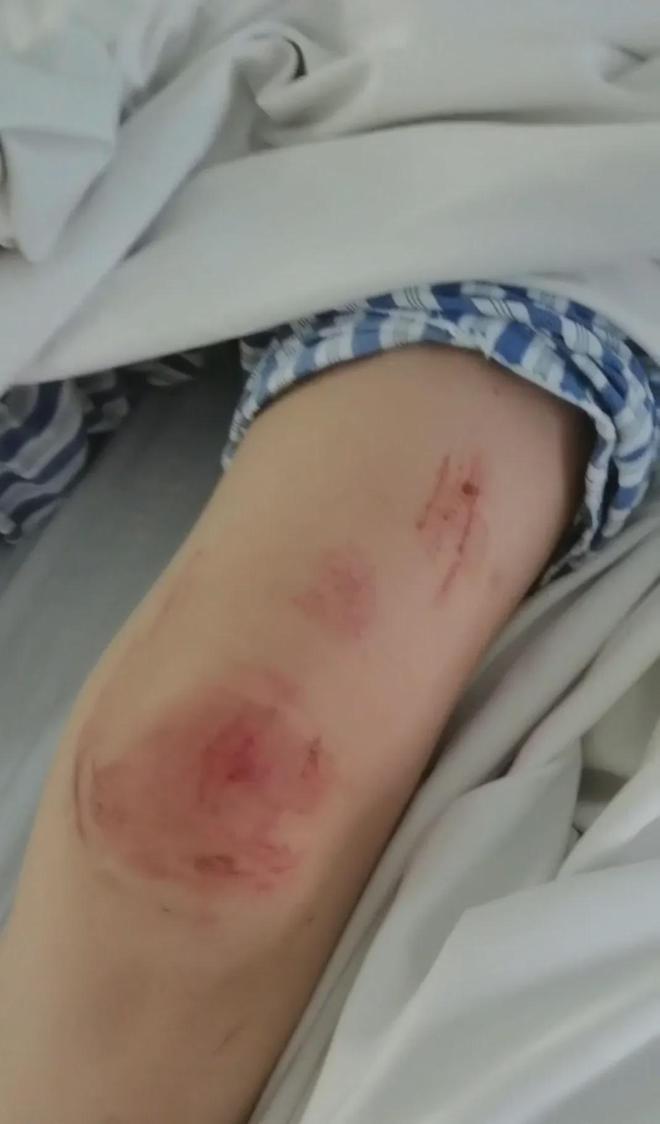 曹女身上的伤。(取材自钱江晚报)