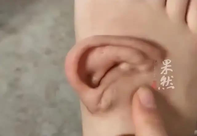 孙女士的耳朵被「寄养」在脚背上。（取材自齐鲁晚报）