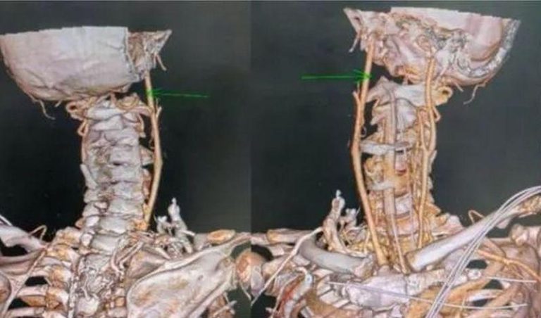 箭头所指部位为寰枕关节脱位。（取材自南都N视频）