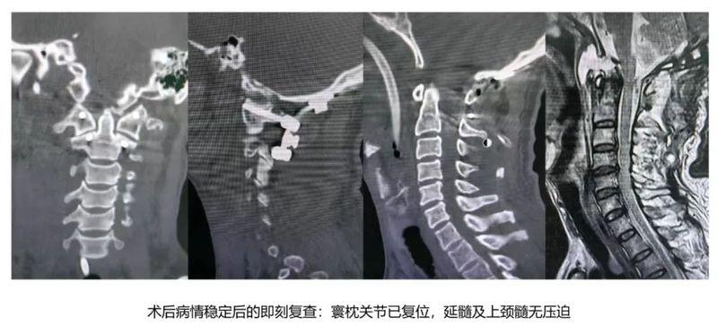 箭头所指部位为寰枕关节脱位。（取材自南都N视频）