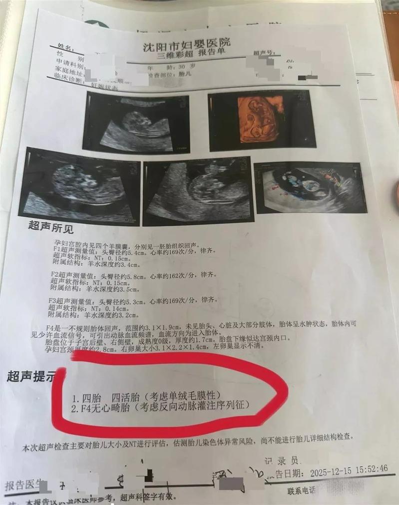 王女第一次产检时,只有一胎。(取材自极目新闻)