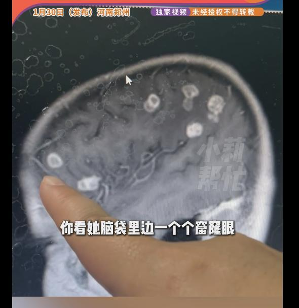 河南郑州6岁女孩跟家人回老家大扫除,脑子被烟曲霉「啃」出20多个洞。(取材自钱江晚报)