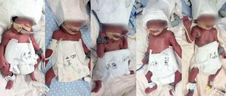 生命极致奇迹…24岁新疆产妇生5胞胎 几率六千万分之一 24岁新疆产妇诞5胞胎。(取材自极目新闻)