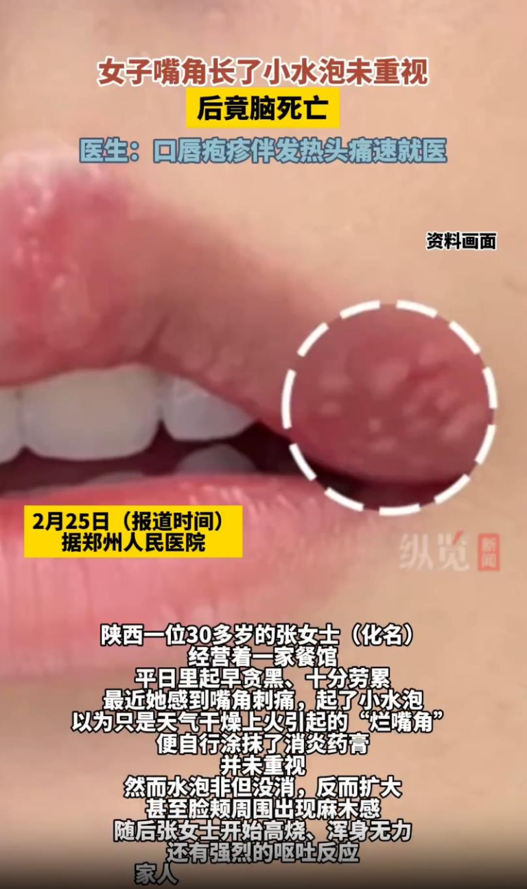 「嘴角水泡」以为火气大 陕西30岁女当晚脑死 全网炸锅 陕西30多岁女子嘴角起了小水泡,不料当晚被医师声明脑死亡。示意图。(视频截屏)