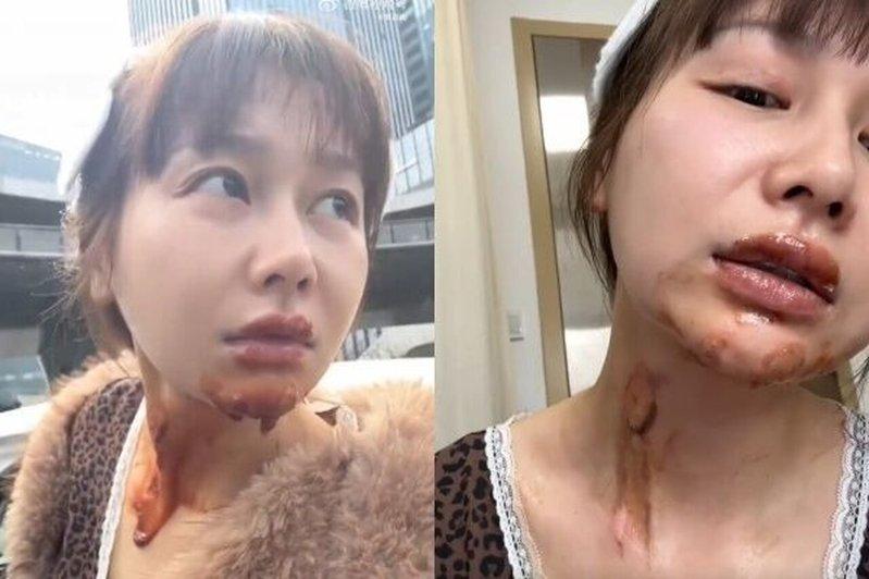 女演员王添羽被火灼伤。(取材自微博)