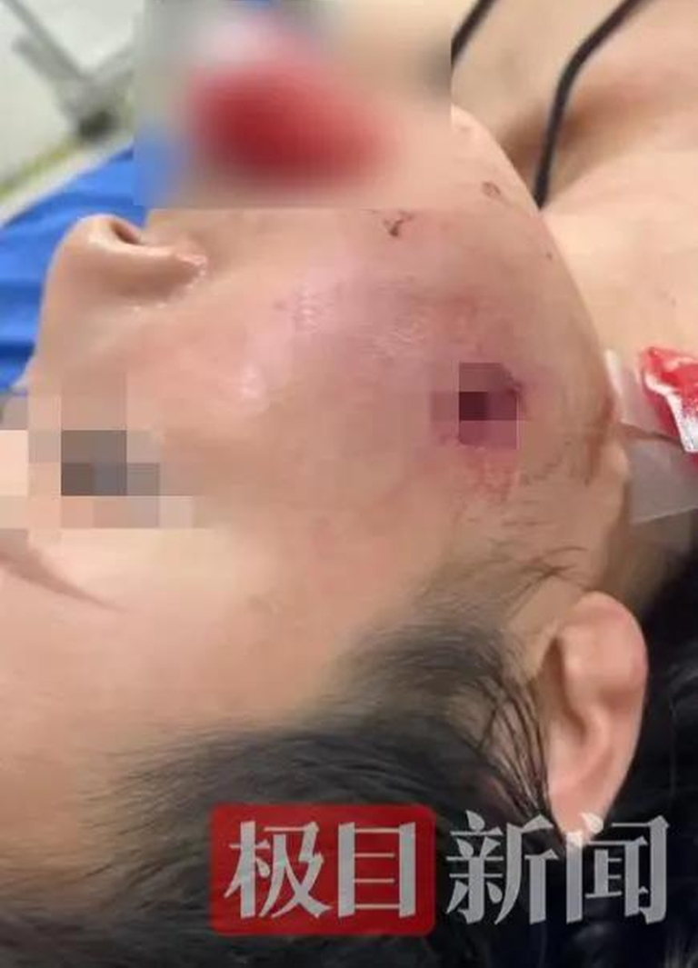 冯女士母亲脸部留下弹孔 。（取材自极目新闻／受访者供图）