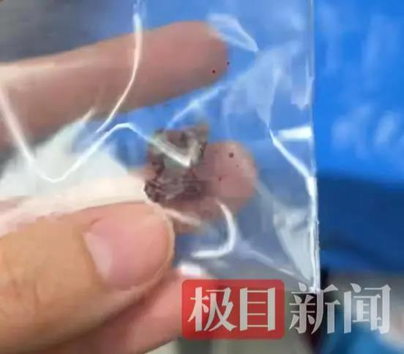 从冯女士母亲嘴里取出的子弹 。（取材自极目新闻／受访者供图）