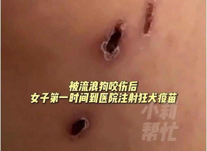 河南焦作一名女子被流浪狗咬伤。图为伤口画面。（取材自红星新闻）