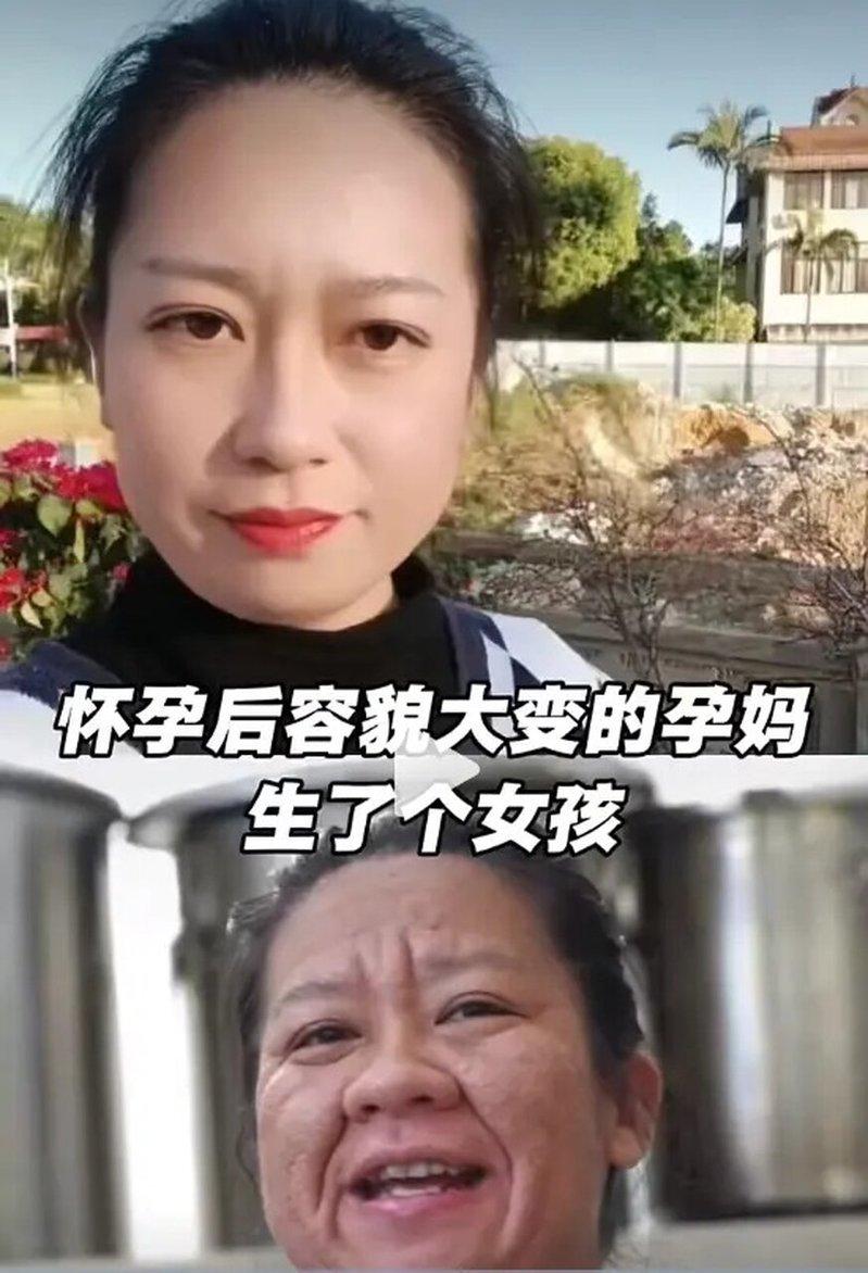 云南一名32岁女子怀孕后容貌明显改变,长痘、毛孔粗大、肤色暗沉,甚至皱纹加深(下...