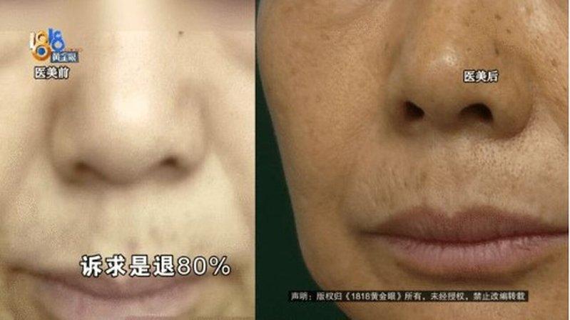 雷女提供的医美前后对比图。（取材自1818黄金眼 ）