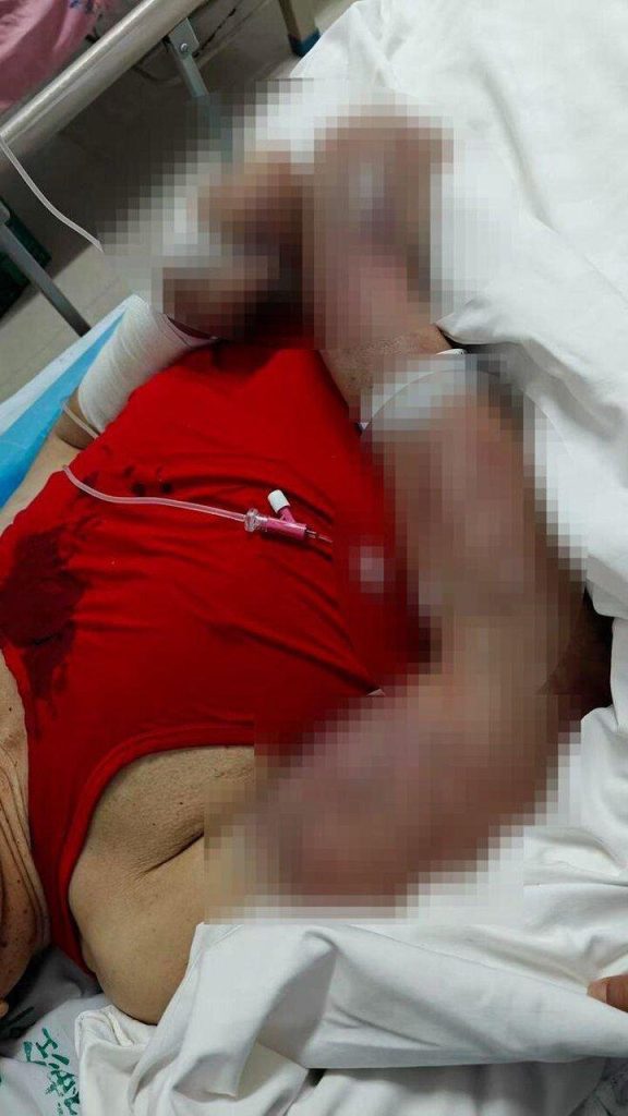 一句「你为何这么高级」 73岁老人被83岁室友打到大小便失禁 被养老院室友打到全身多处骨折、颅脑损伤并出现大小便失禁的马姓老人在医院接受救治。...