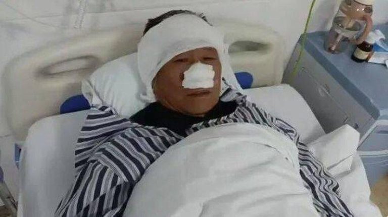 70岁的曾凡林在与男子搏斗中，鼻子被对方咬掉吞入肚中。（取材自潇湘晨报）