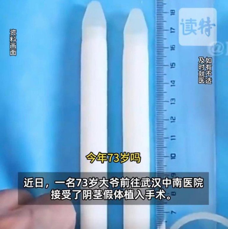 73岁大爷植入的阴茎假体长19公分。（取材自读特新闻）