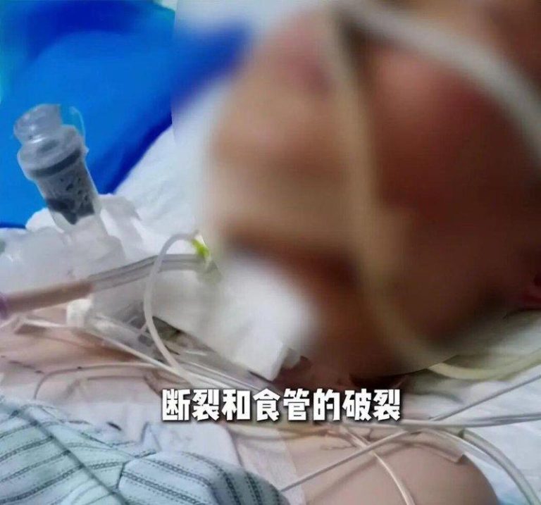 河南少年骑车遭绳割喉 气管食道全断 忍痛托着脑袋走回家 河南一名13岁男孩骑车前往补习班途中,颈部遭绳勒,导致气管与食道破裂,目前仍在I...