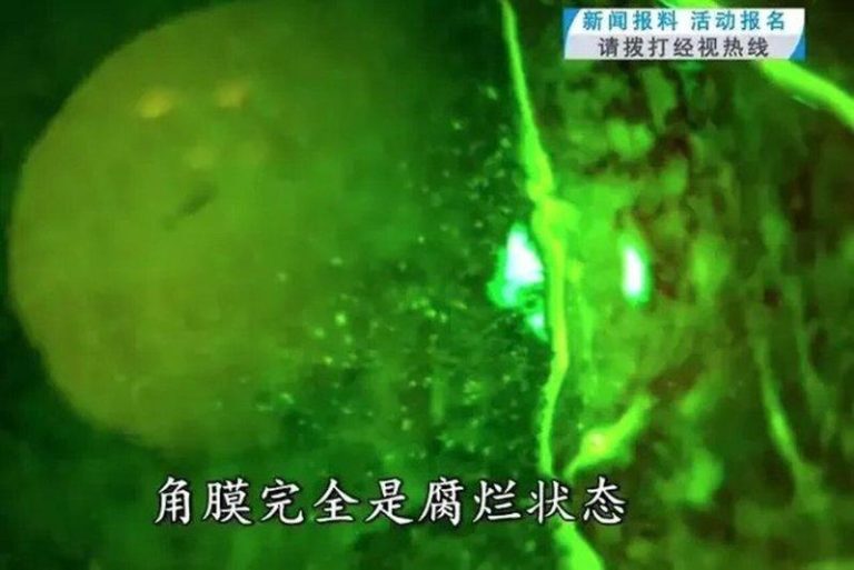 蚊子飞入眼 福建男揉几下 竟然角膜全腐烂、差点失明 男子的眼角膜全腐烂。(取材光明网)