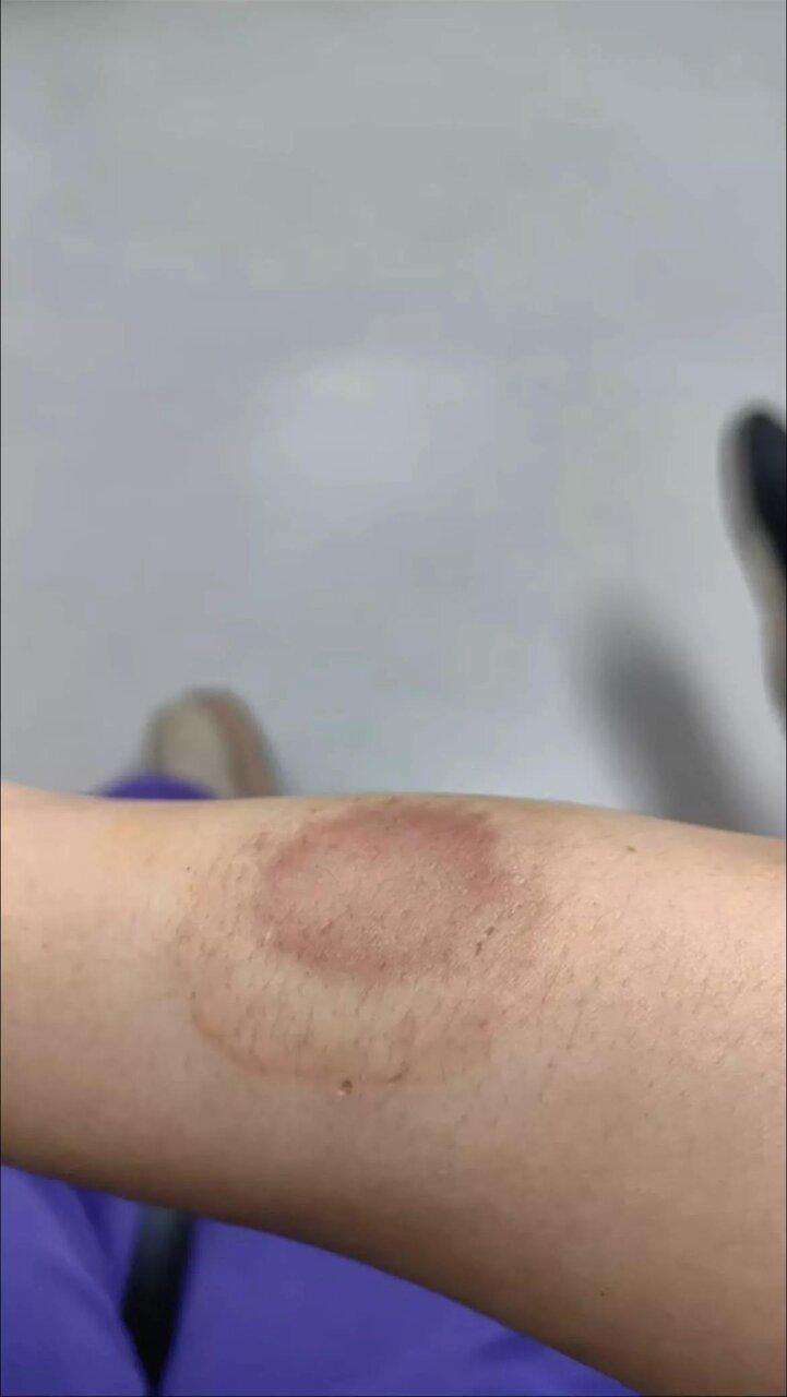 被殴打的女子手臂上还有一处牙印。(视频截屏)