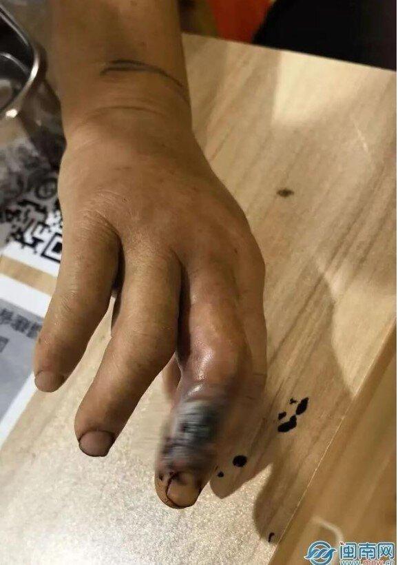 陈阿姨被咬伤的手指发黑溃烂。(取材自闽南网)