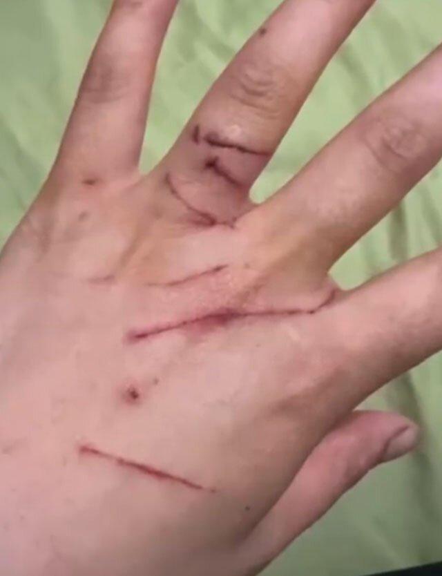 陈女士的手布满抓痕。(视频截屏)