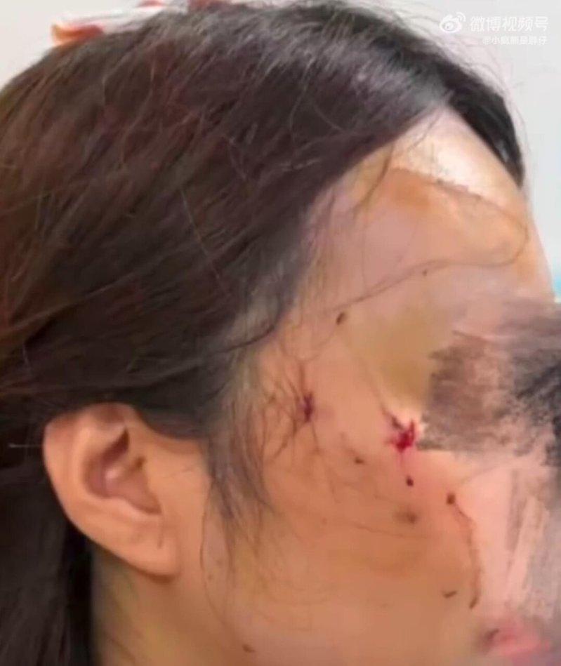 陈女士被猫攻击脸部。(视频截屏)