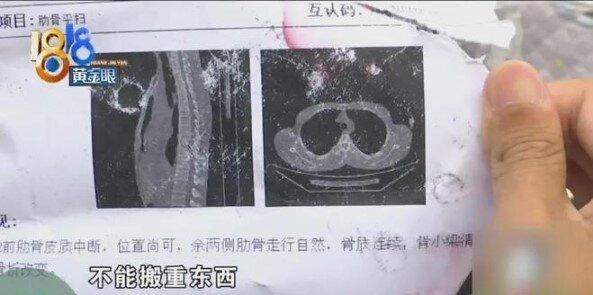 影像诊断结果,小李的肋骨骨折。(取材自1818黄金眼)