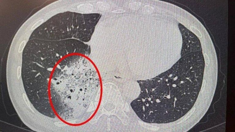 吹一晚空调高烧不退 杭州妇肺白了大半 医:很多人忽视这点… 杭州一名78岁的何阿姨因吹了一晚空调高烧不退、整夜剧烈咳嗽,就医发现右侧肺部已白...