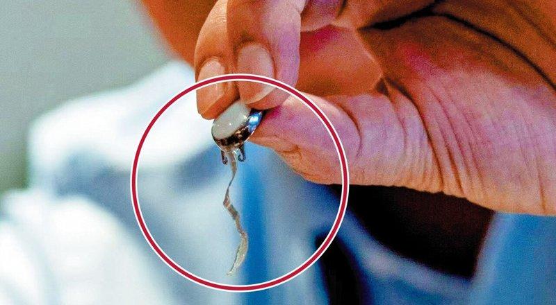 中南大学湘雅医院试验使用的IMIE智能视网膜系统内核植入器件,可为失明患者重建人...