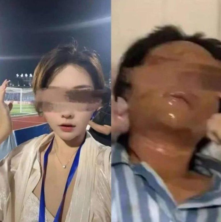 湖南男追求不成、多次报复 女主播拆包裹被炸到毁容 左图为思思被炸伤前,右图为她在医院接受治疗。(取材自中新周刊)