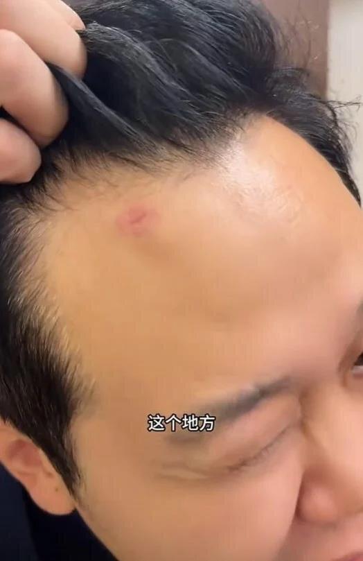 王先生的额头因为被枪抵住而受伤。(取材自都市快报)