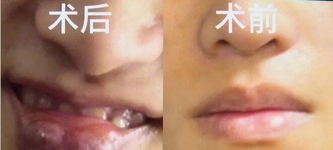刘小姐男友术前术后对比图。(取材自1818黄金眼)