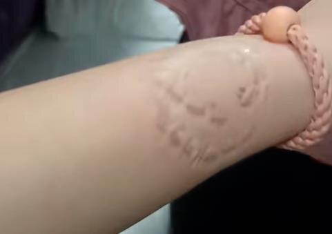 女子称乘火车卧铺被大妈占据,争吵中手腕被咬后起疱疹。(取材自大河报)